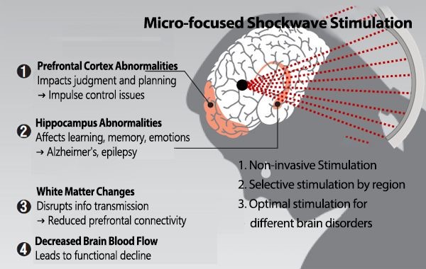 (Figure 1) Key Features of Micro-Shockwave Brain Disorder Treatment